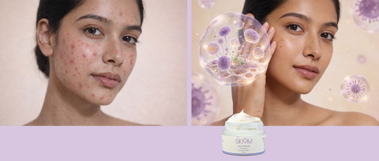 Acne Isn’t Just Oil - It’s Your Skin’s Ecosystem Asking for Balance