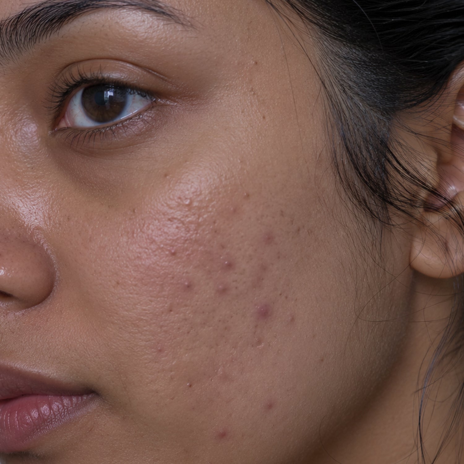 Acne Shield Collection